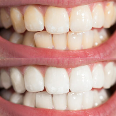 5 Effective Teeth-Whitening Products