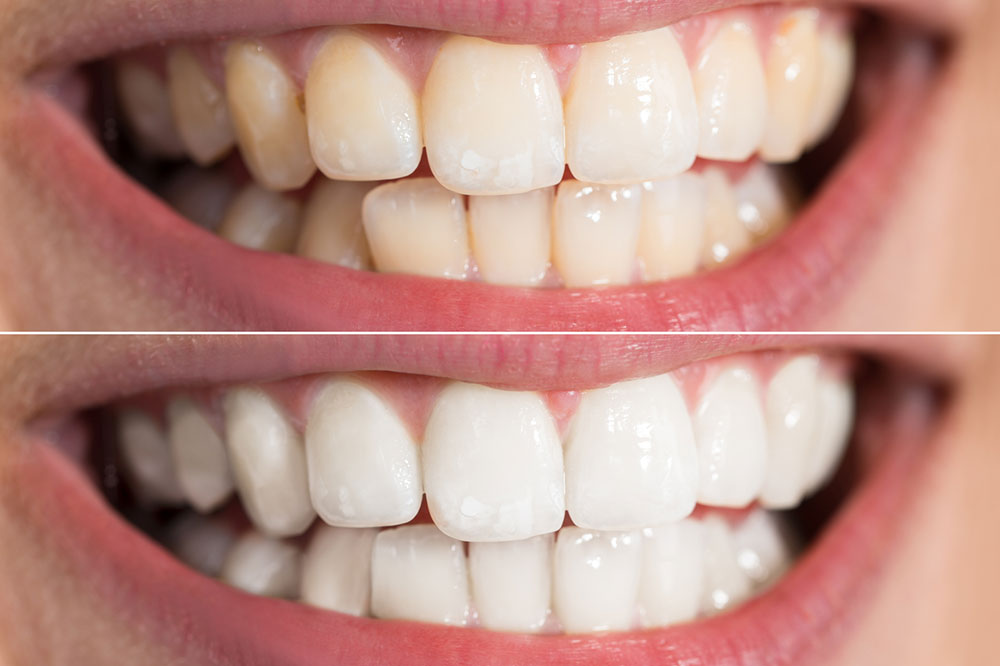 5 Effective Teeth-Whitening Products