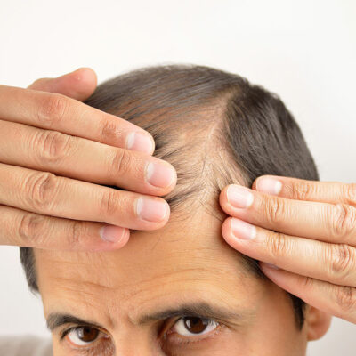 5 Useful Tips for Preventing Hair Loss in Men and Women