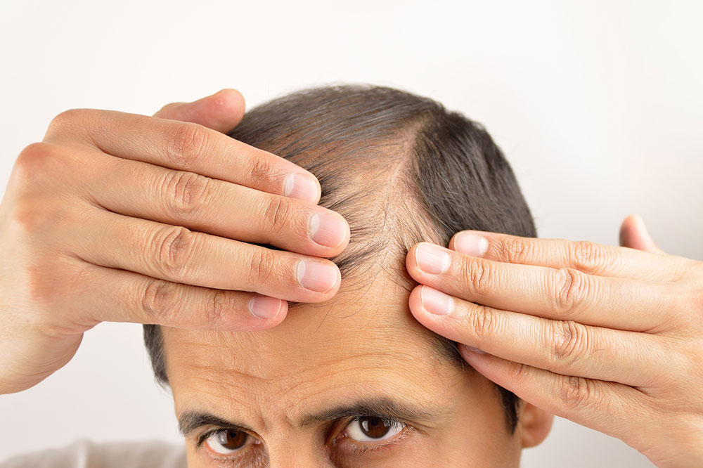 5 Useful Tips for Preventing Hair Loss in Men and Women